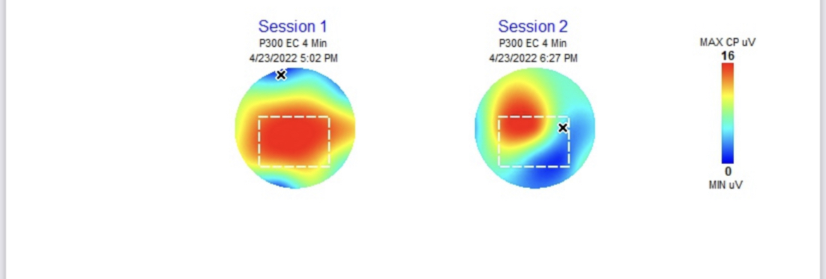 Pre and post Alpha Imprinting P300 brain scans — Post-sports-injury traumatic stress disorder to Healthy regulation
